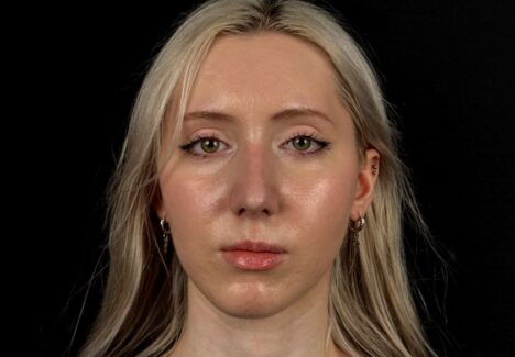 Уменьшение носа в Москве