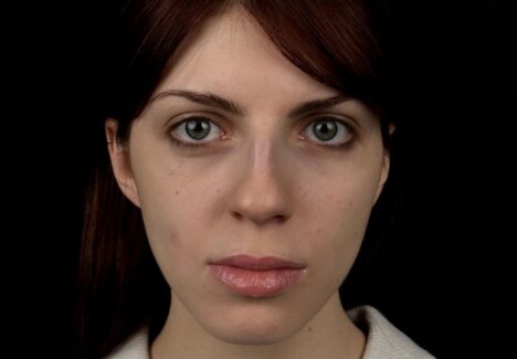 Ринопластика крыльев носа в Москве