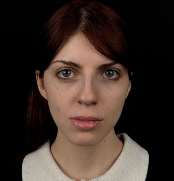 Ринопластика крыльев носа в Москве