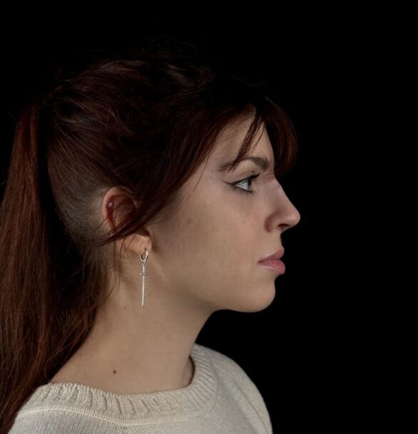 Костная ринопластика в Москве