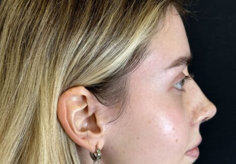 Закрытая ринопластика носа в Москве