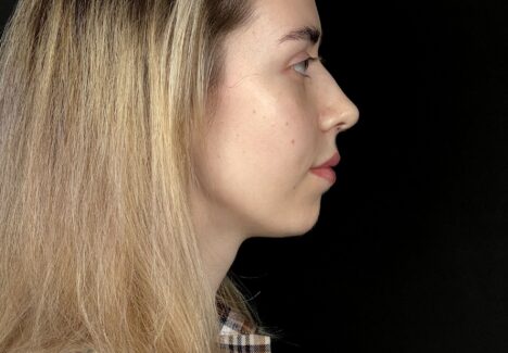 Лазерная ринопластика в Москве