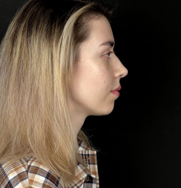 Лазерная ринопластика в Москве