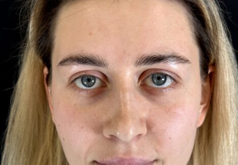 Круговая блефаропластика в Москве