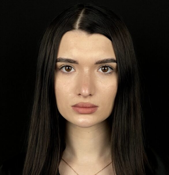 Реберная ринопластика в Москве