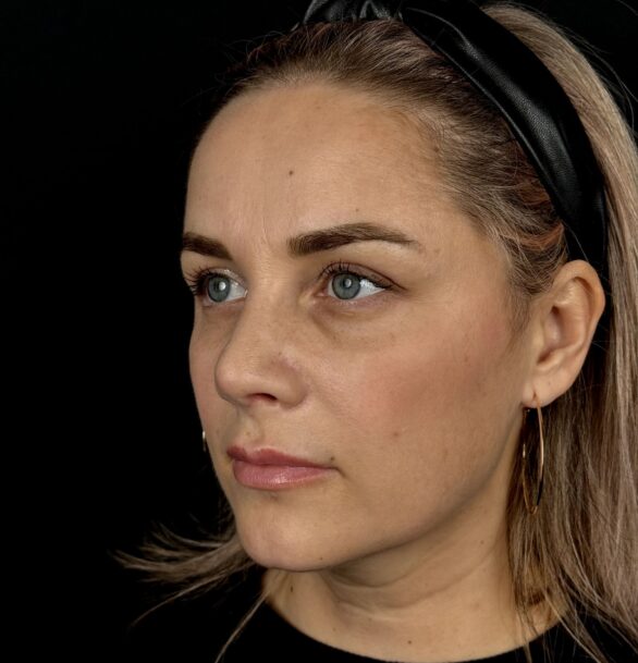 Блефаропластика мешков под глазами в Москве