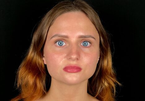 Открытая ринопластика в Москве