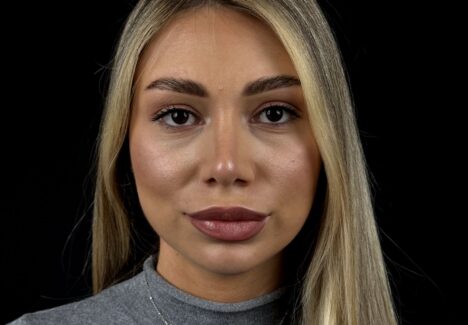 Ринопластика ноздрей в Москве