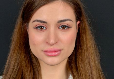 Височная блефаропластика в Москве